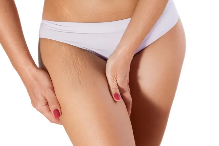 Revitol Stretch Mark Prevention Cream - Tighten, Tone, Smooth, and Strengthen - Image 3